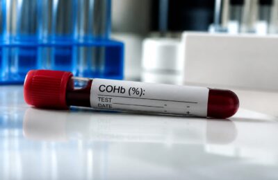 Un nou test de sânge poate prezice riscul de Alzheimer cu ani înainte de apariția simptomelor